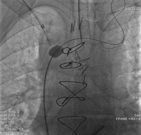 Image of central chest vein