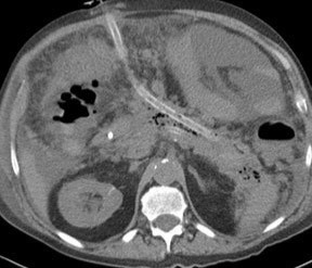 Image of fluid collection drainage catheter placement