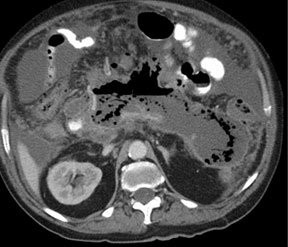 Image of fluid collection drainage catheter placement