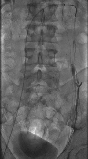 Image of male varicocele embolization