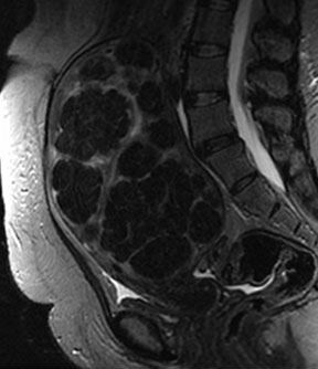 Image of uterine fibroid embolization