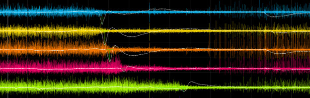 An image of brain activity monitoring showing a spreading depolarization