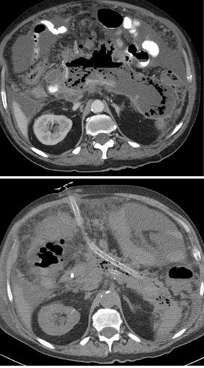 fluid-collection-drainage-catheter-placement