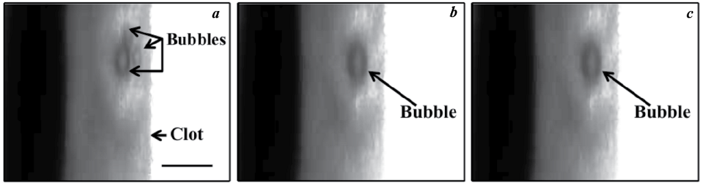 3 panels showing Sonothrombolysis
